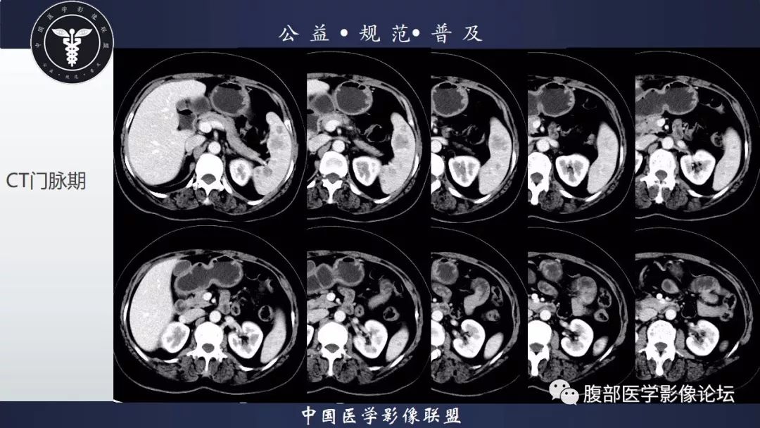 【病例】脾脏窦岸细胞血管瘤三例讨论及文献复习