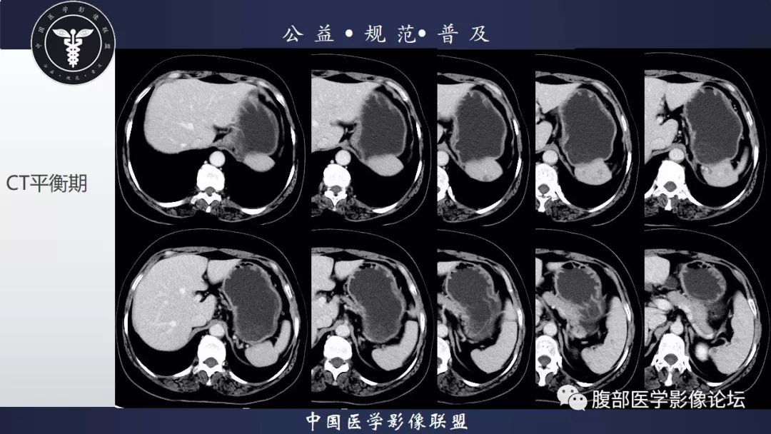 【病例】脾脏窦岸细胞血管瘤三例讨论及文献复习