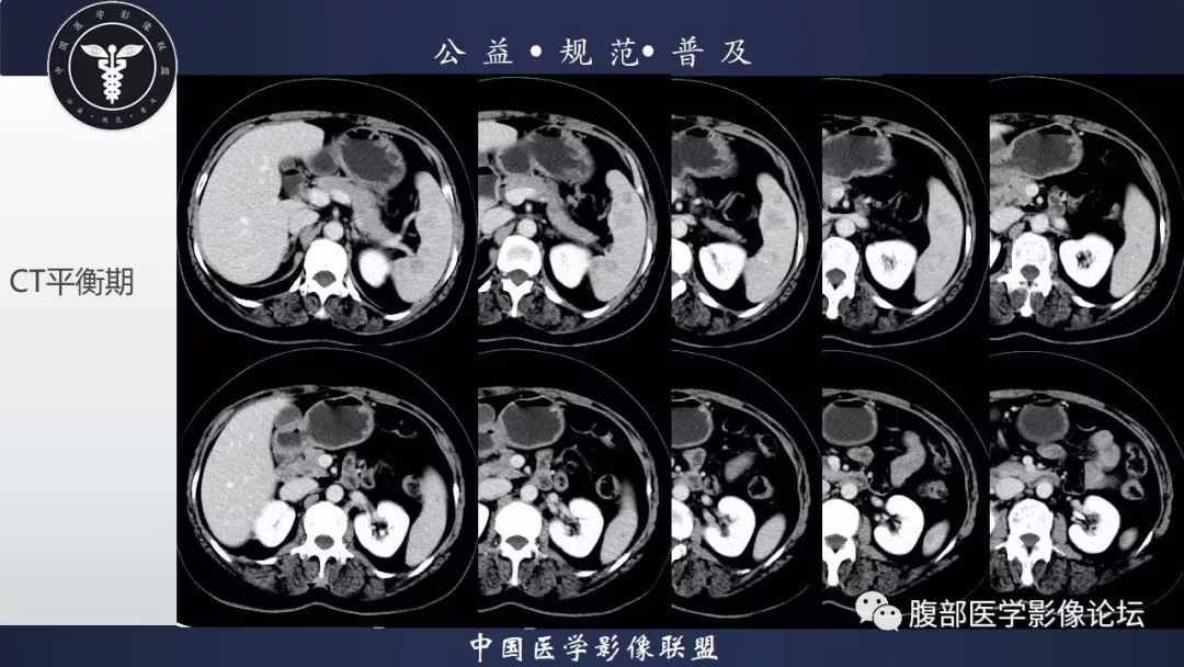 【病例】脾脏窦岸细胞血管瘤三例讨论及文献复习
