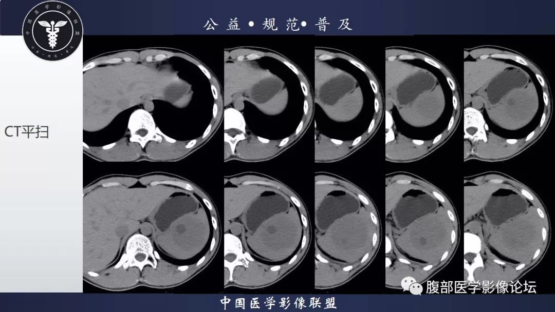 【病例】脾脏窦岸细胞血管瘤三例讨论及文献复习