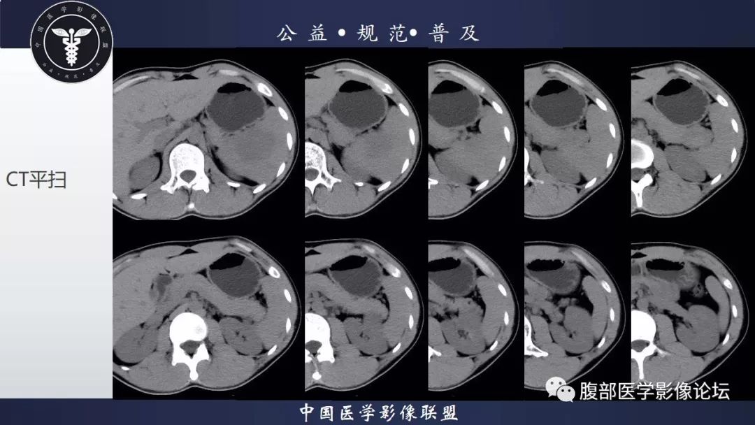【病例】脾脏窦岸细胞血管瘤三例讨论及文献复习