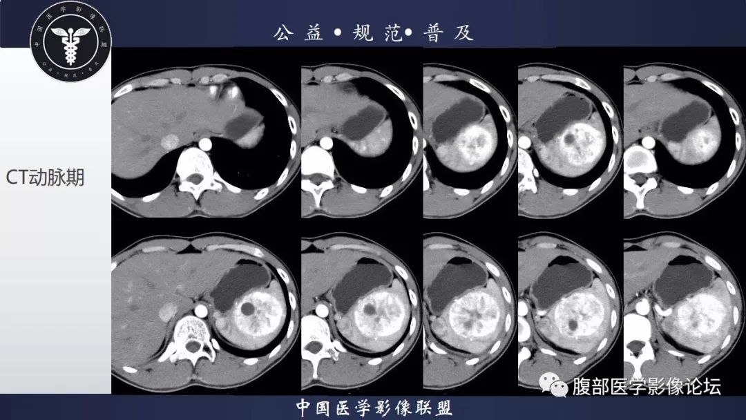 【病例】脾脏窦岸细胞血管瘤三例讨论及文献复习