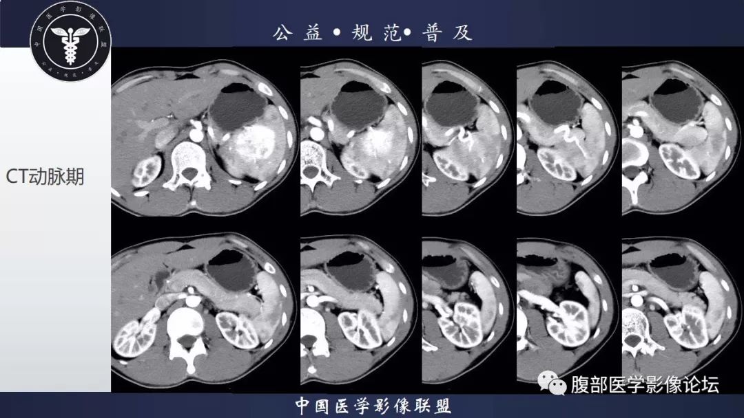 【病例】脾脏窦岸细胞血管瘤三例讨论及文献复习