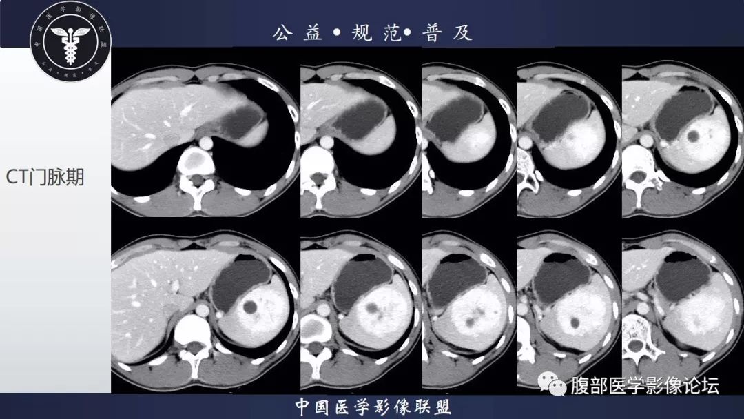 【病例】脾脏窦岸细胞血管瘤三例讨论及文献复习
