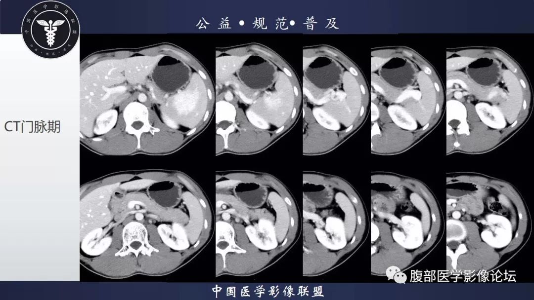 【病例】脾脏窦岸细胞血管瘤三例讨论及文献复习