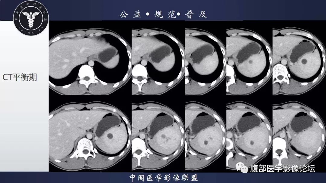 【病例】脾脏窦岸细胞血管瘤三例讨论及文献复习