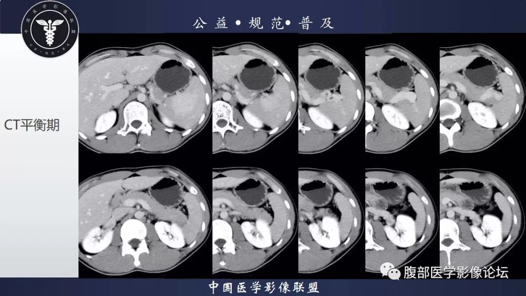 【病例】脾脏窦岸细胞血管瘤三例讨论及文献复习