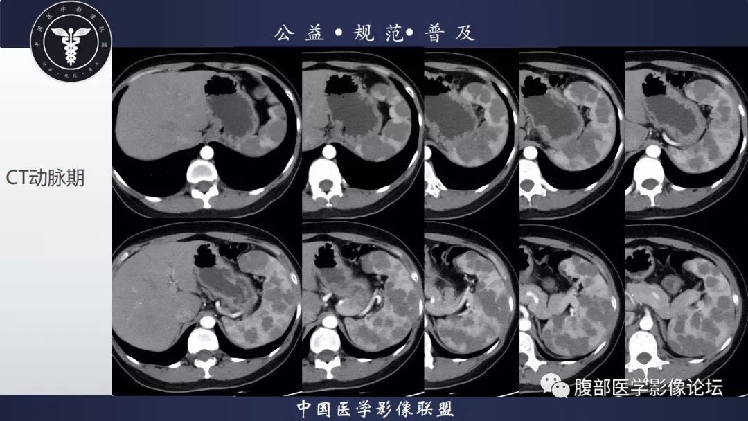 【病例】脾脏窦岸细胞血管瘤三例讨论及文献复习