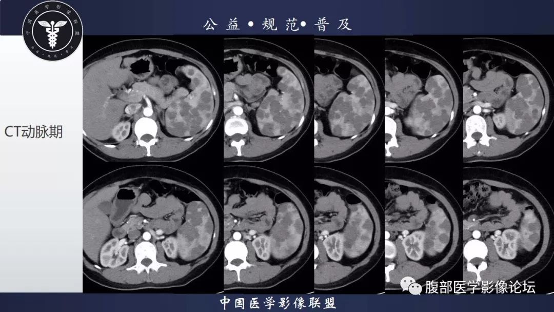 【病例】脾脏窦岸细胞血管瘤三例讨论及文献复习