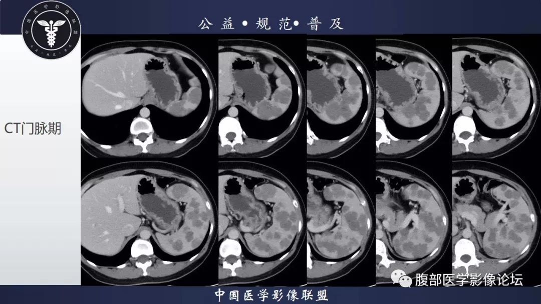 【病例】脾脏窦岸细胞血管瘤三例讨论及文献复习