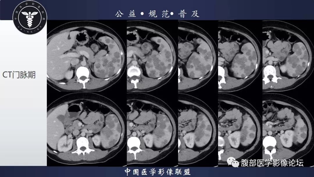 【病例】脾脏窦岸细胞血管瘤三例讨论及文献复习