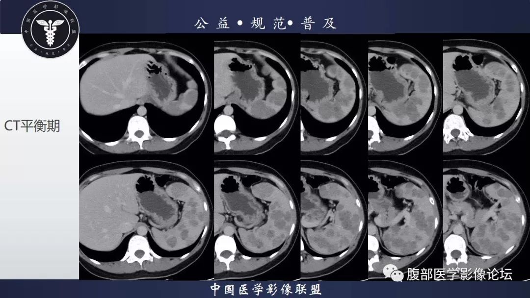 【病例】脾脏窦岸细胞血管瘤三例讨论及文献复习