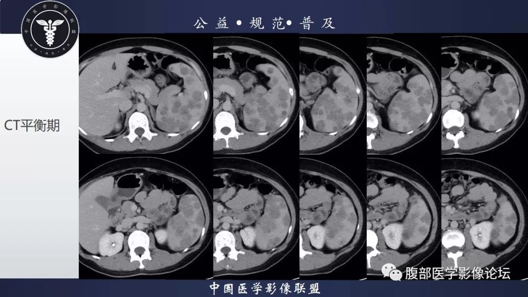 【病例】脾脏窦岸细胞血管瘤三例讨论及文献复习