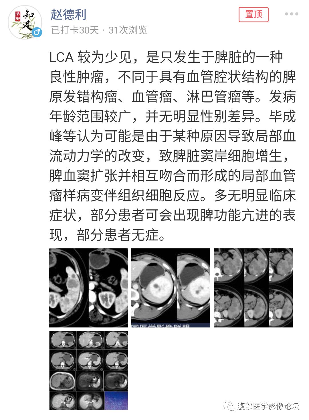 【病例】脾脏窦岸细胞血管瘤三例讨论及文献复习