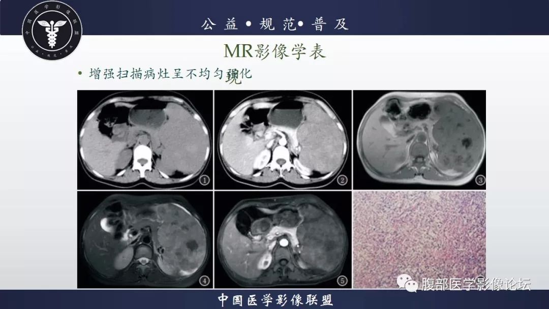【病例】脾脏窦岸细胞血管瘤三例讨论及文献复习