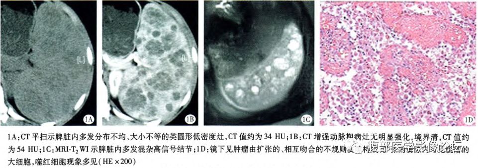 【病例】脾脏窦岸细胞血管瘤三例讨论及文献复习