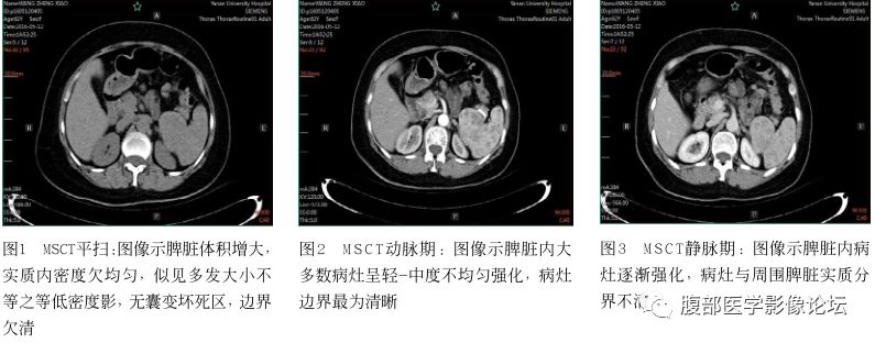 【病例】脾脏窦岸细胞血管瘤三例讨论及文献复习