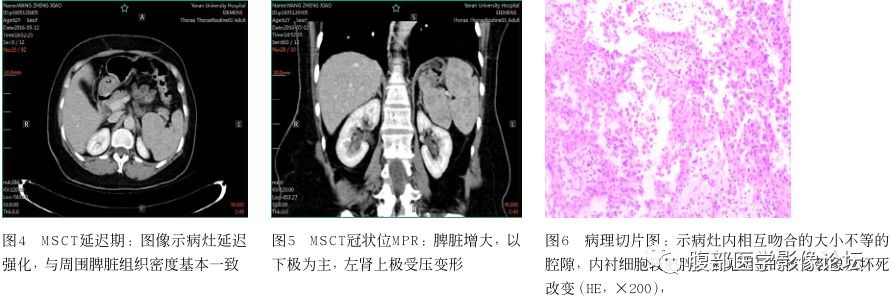 【病例】脾脏窦岸细胞血管瘤三例讨论及文献复习