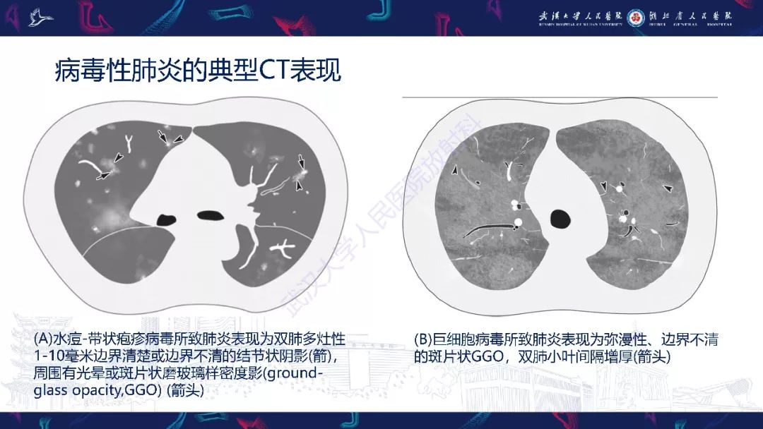 【PPT】病毒性肺炎影像诊断