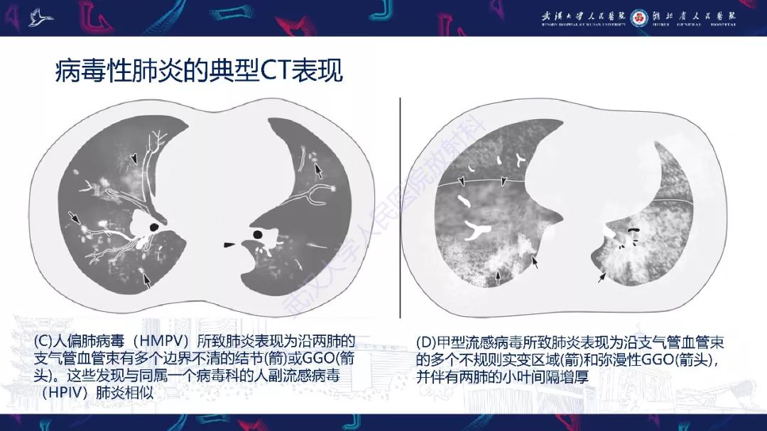 【PPT】病毒性肺炎影像诊断