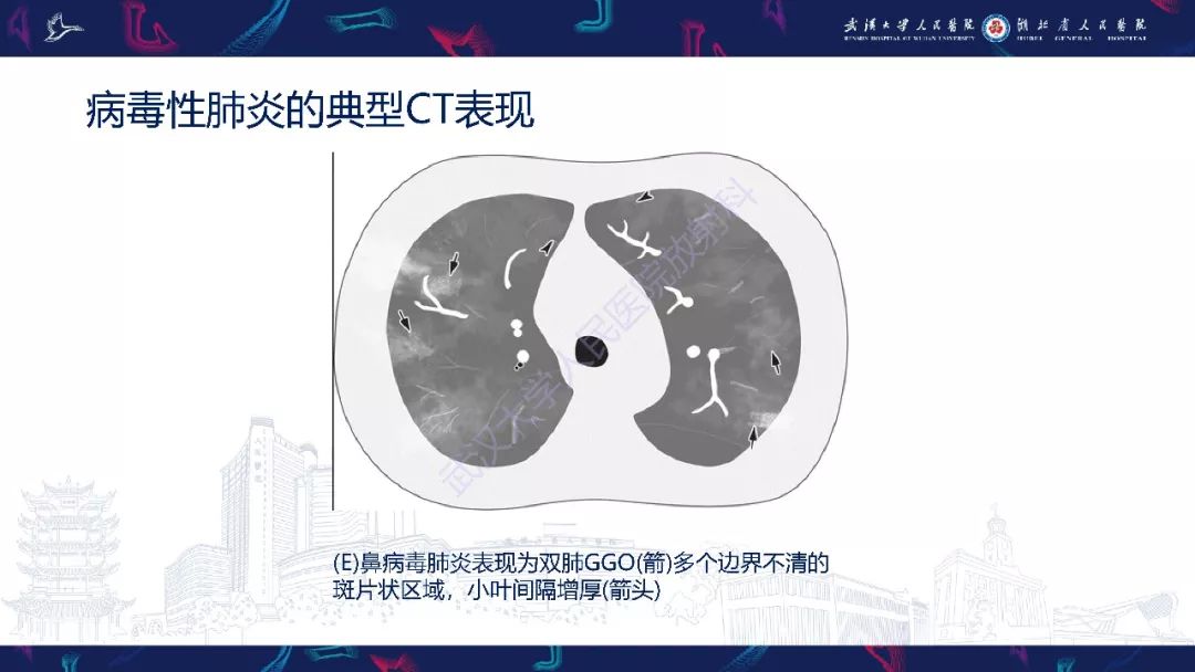 【PPT】病毒性肺炎影像诊断