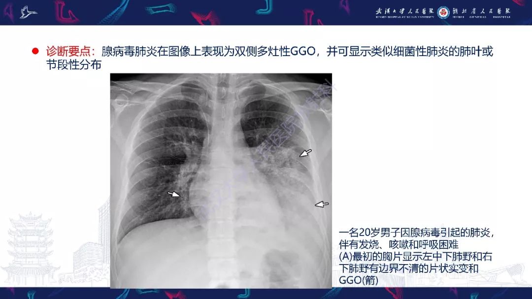 【PPT】病毒性肺炎影像诊断