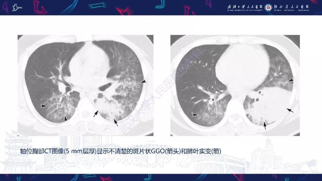 【PPT】病毒性肺炎影像诊断