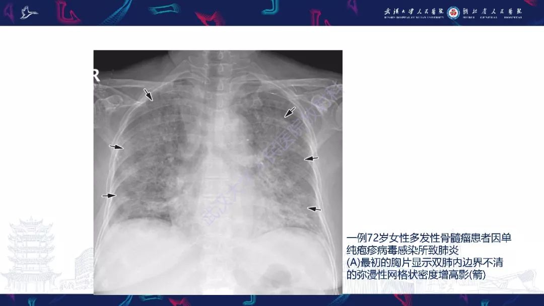 【PPT】病毒性肺炎影像诊断