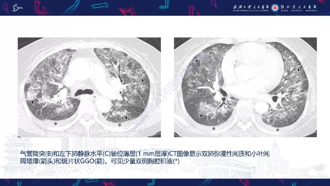 【PPT】病毒性肺炎影像诊断
