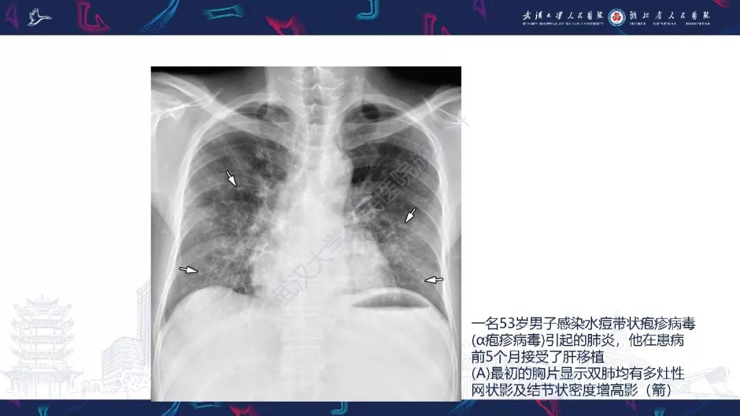 【PPT】病毒性肺炎影像诊断