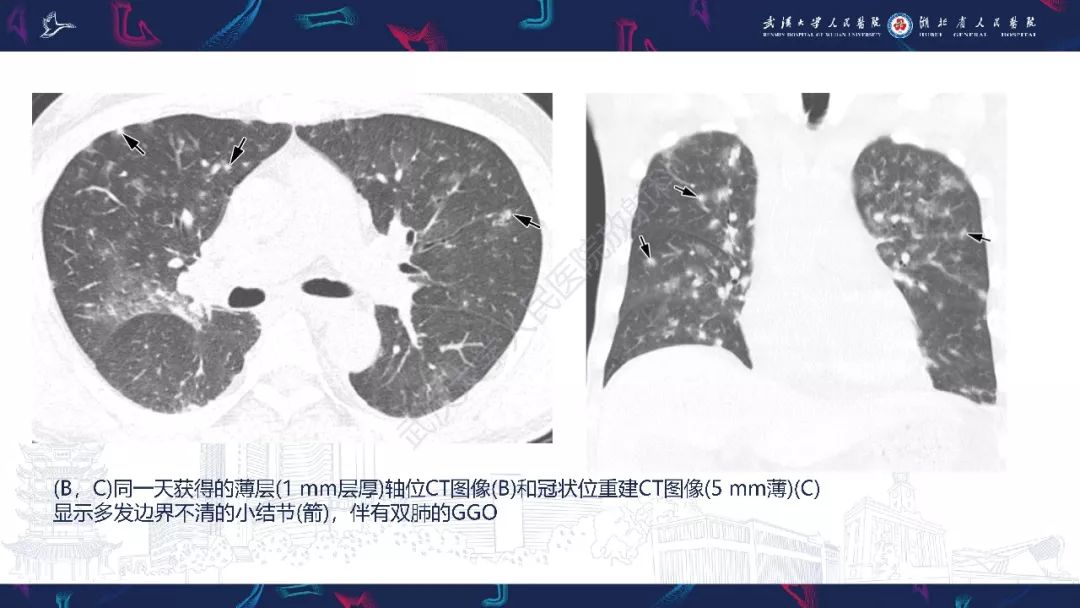 【PPT】病毒性肺炎影像诊断