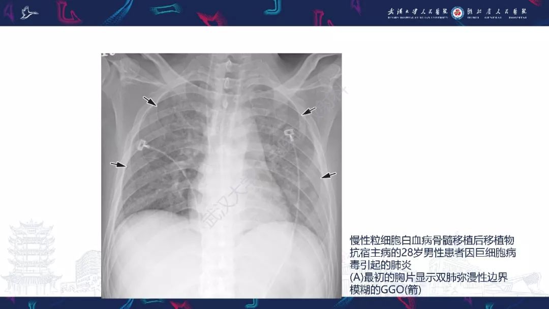 【PPT】病毒性肺炎影像诊断