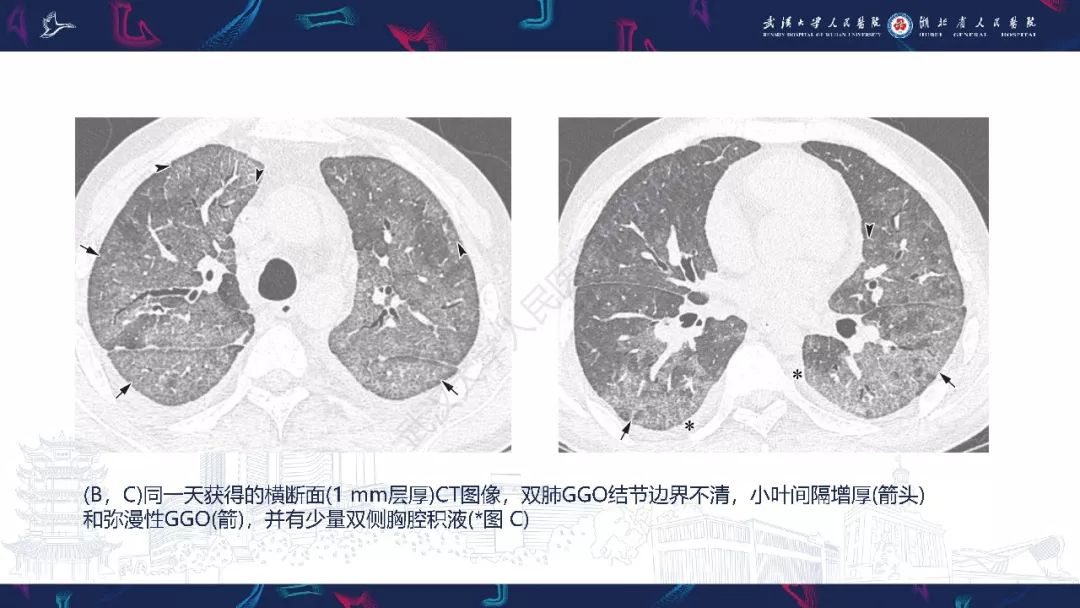 【PPT】病毒性肺炎影像诊断