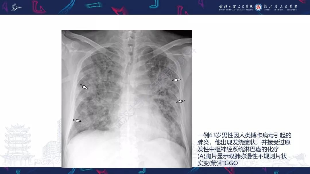 【PPT】病毒性肺炎影像诊断