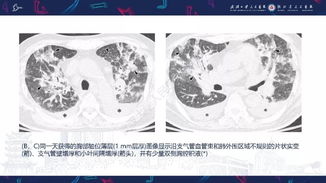 【PPT】病毒性肺炎影像诊断