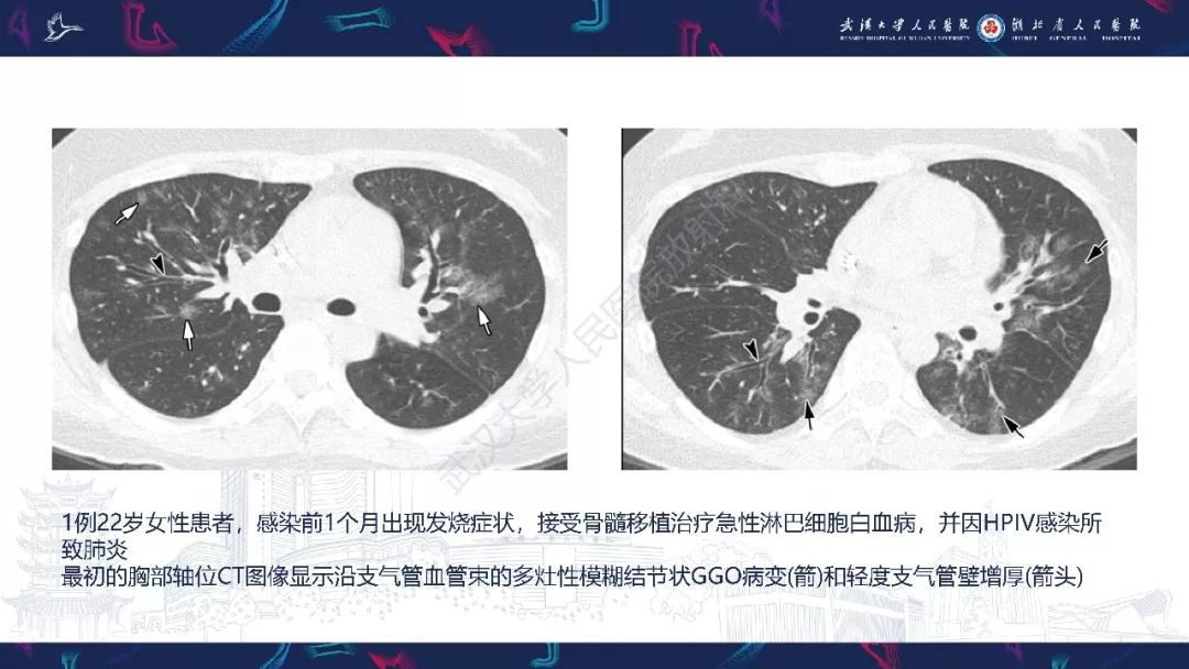 【PPT】病毒性肺炎影像诊断