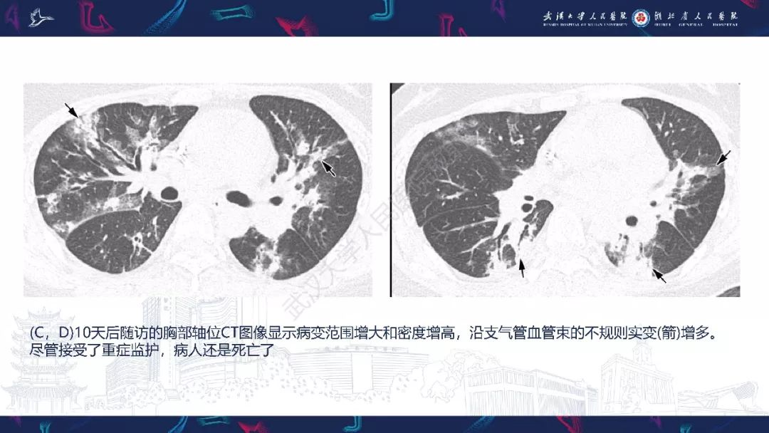 【PPT】病毒性肺炎影像诊断