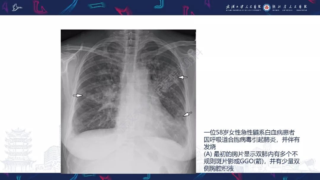 【PPT】病毒性肺炎影像诊断