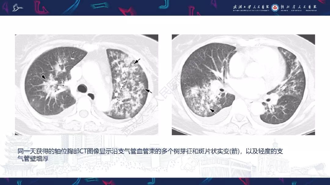 【PPT】病毒性肺炎影像诊断