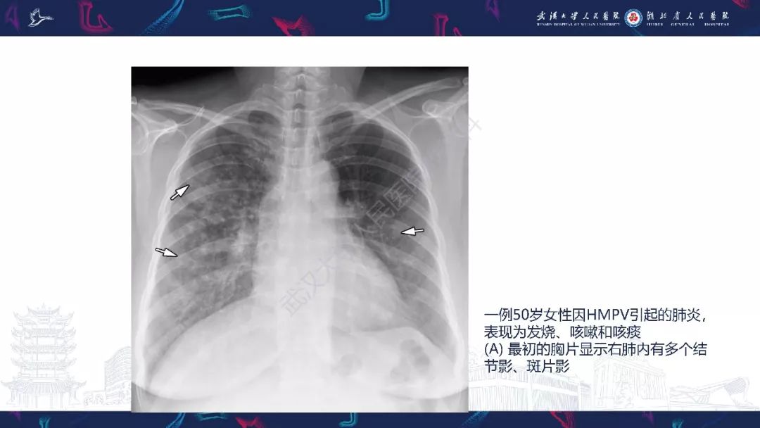 【PPT】病毒性肺炎影像诊断