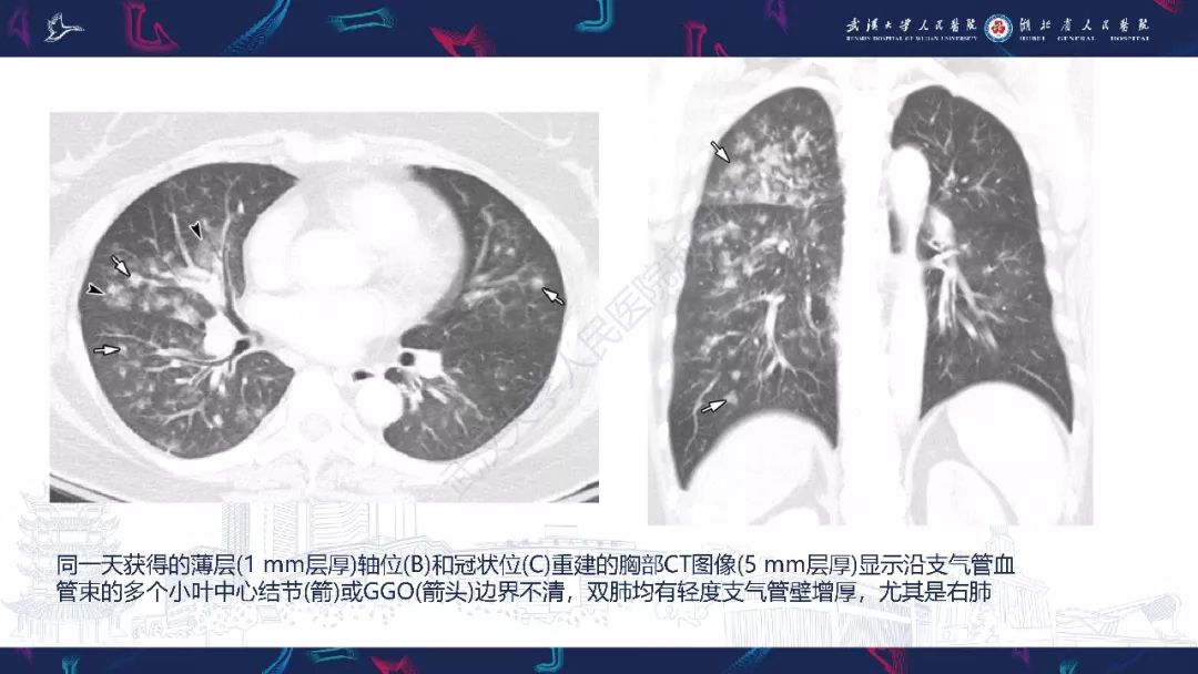 【PPT】病毒性肺炎影像诊断