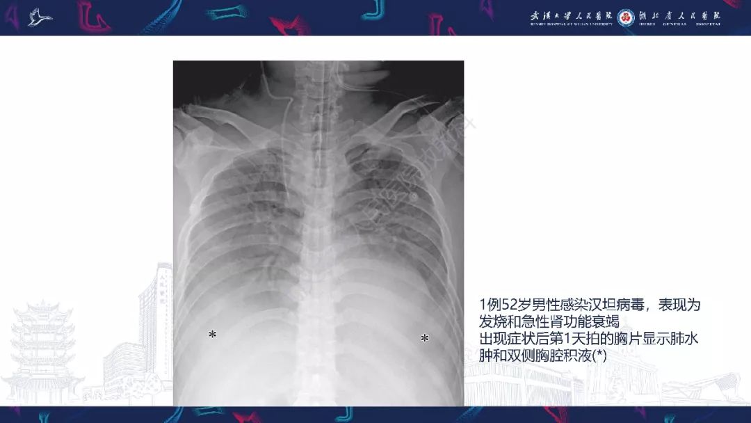 【PPT】病毒性肺炎影像诊断