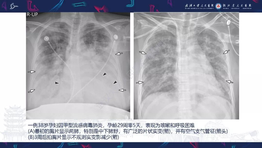 【PPT】病毒性肺炎影像诊断
