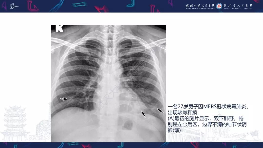 【PPT】病毒性肺炎影像诊断