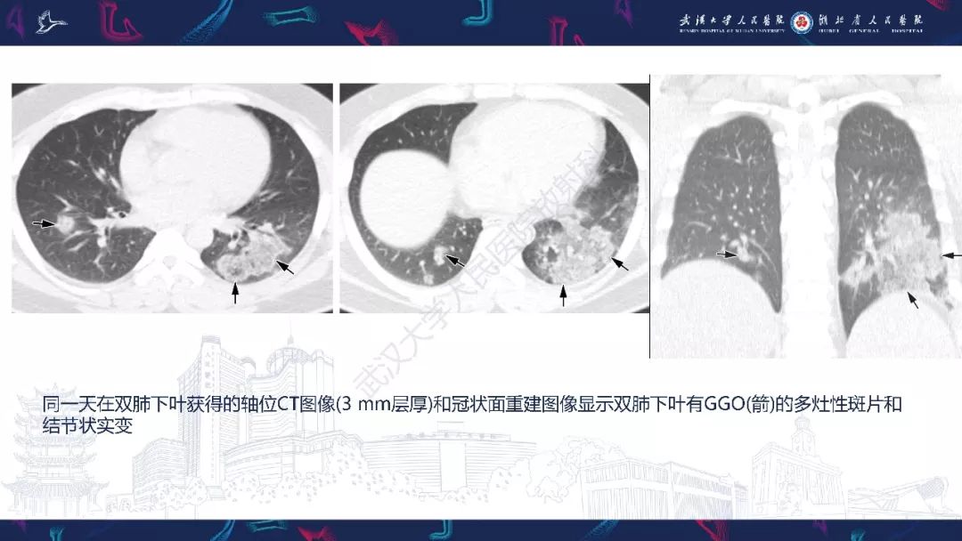 【PPT】病毒性肺炎影像诊断