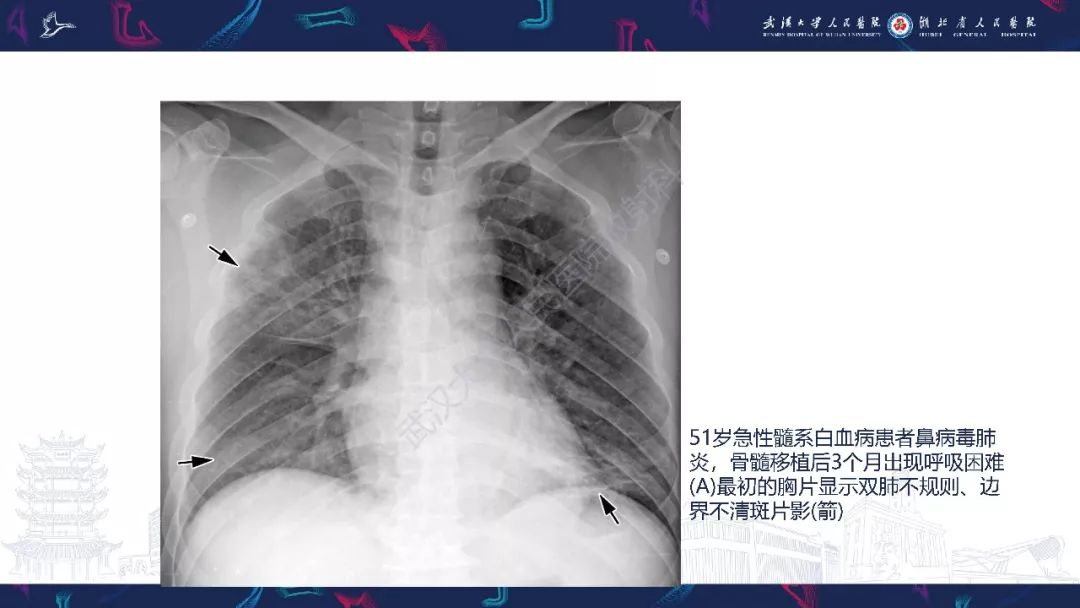 【PPT】病毒性肺炎影像诊断