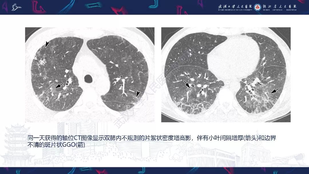 【PPT】病毒性肺炎影像诊断