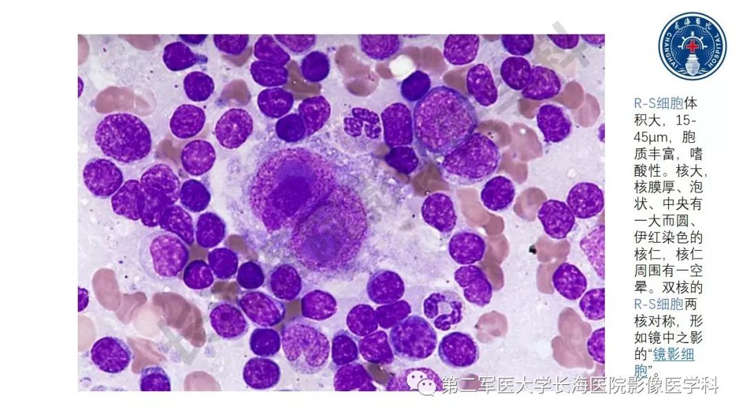 【PPT】胰腺淋巴瘤