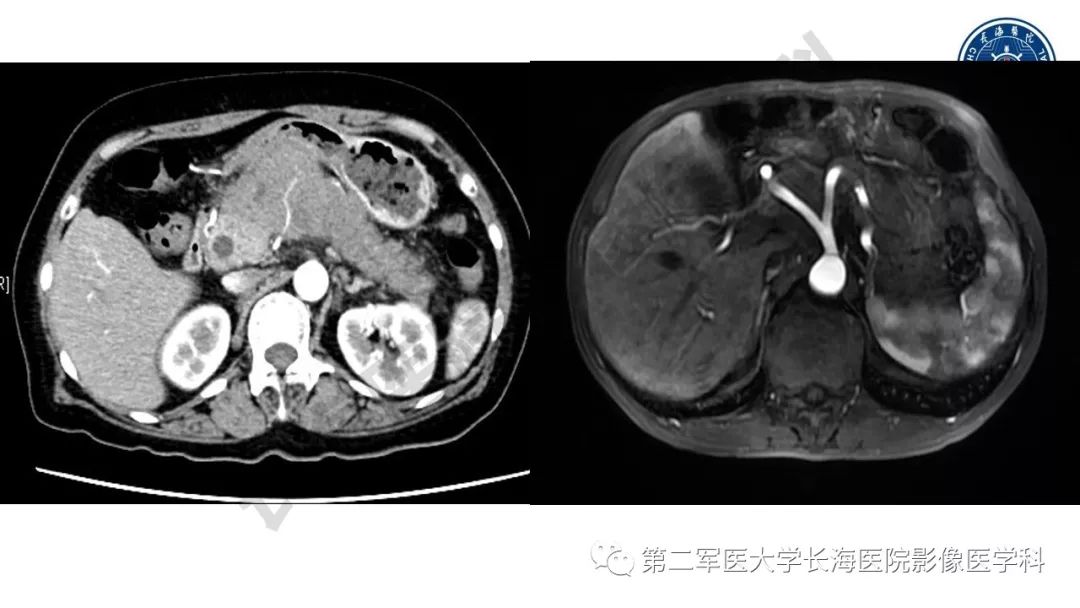 【PPT】胰腺淋巴瘤