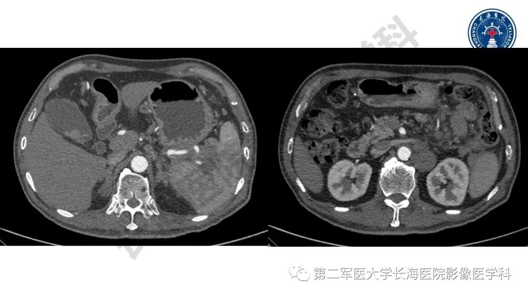 【PPT】胰腺淋巴瘤
